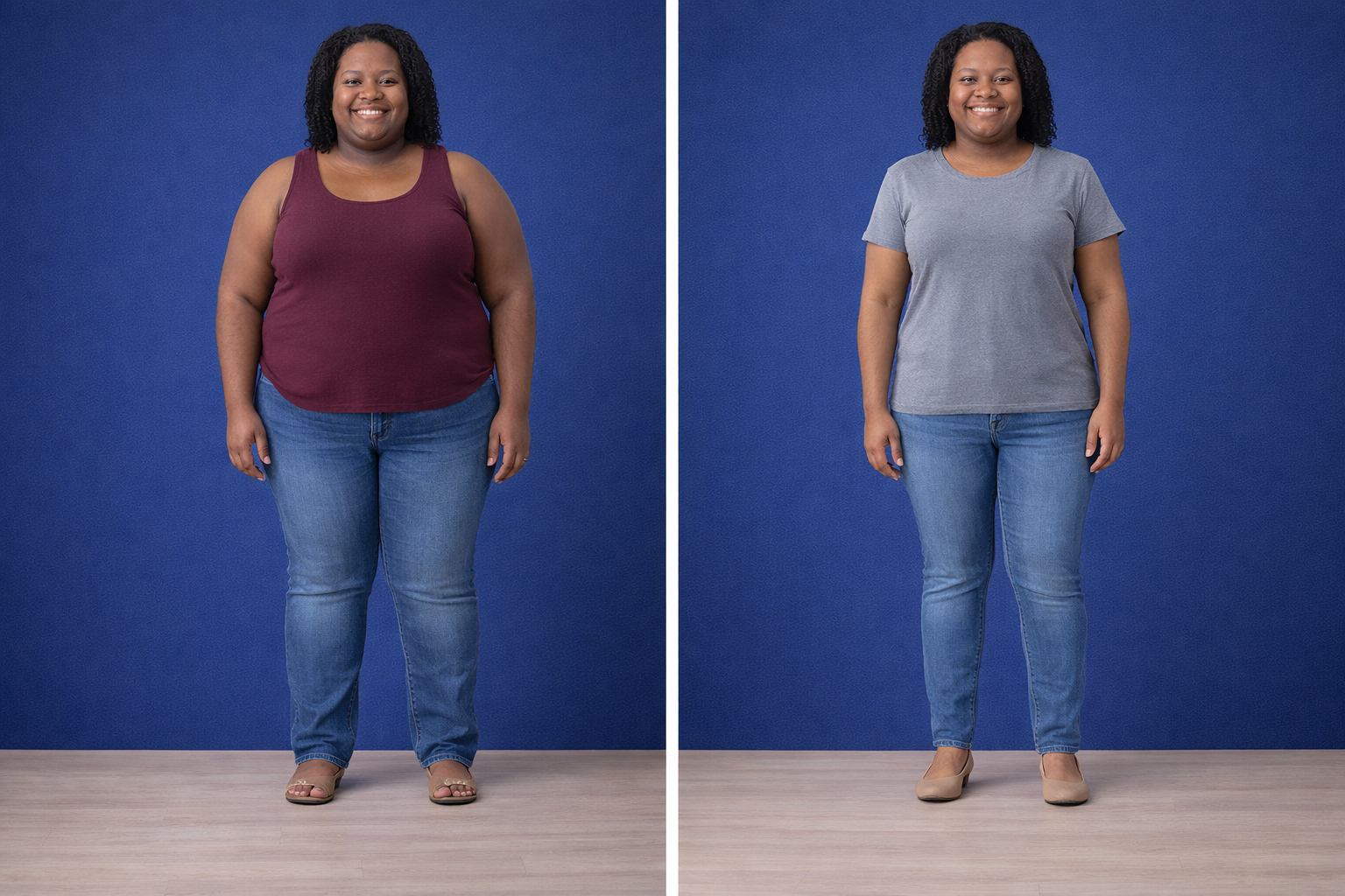 Gastric Bypass — 18 months post-op